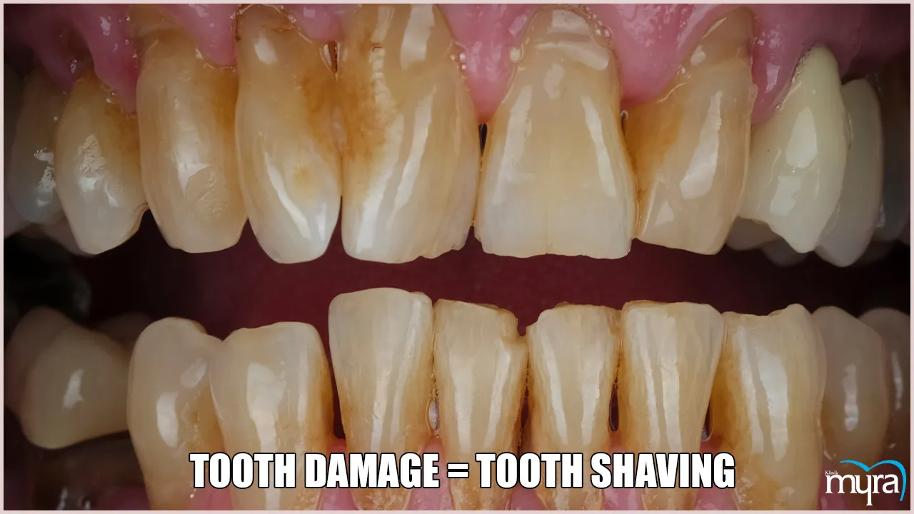 Enamel Shaping Definition