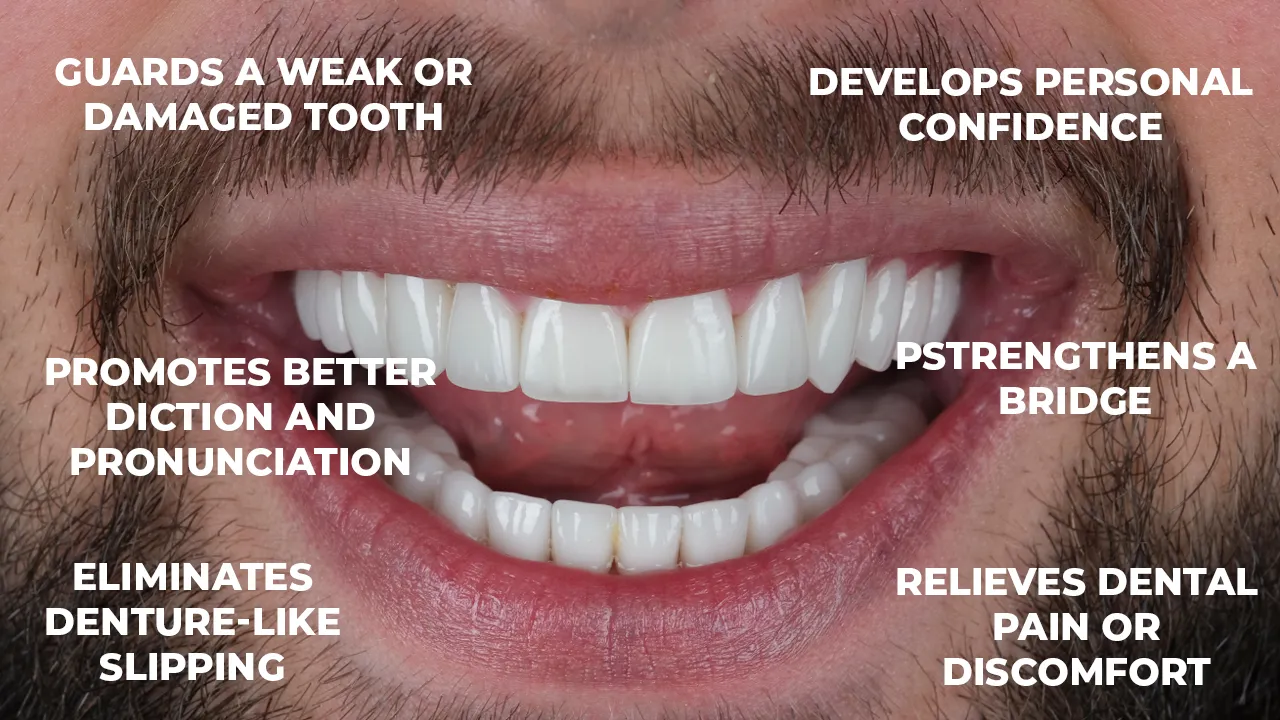 Types of Dental Crown