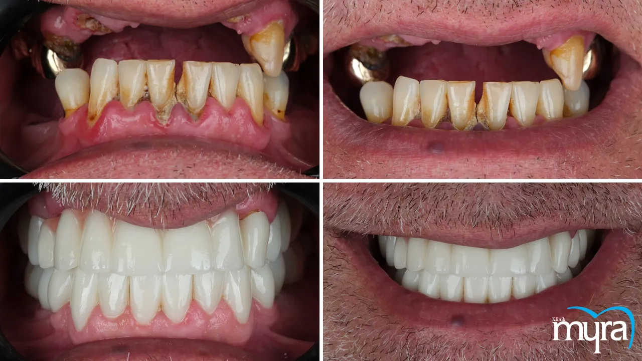 Immediate load dental implant Definition