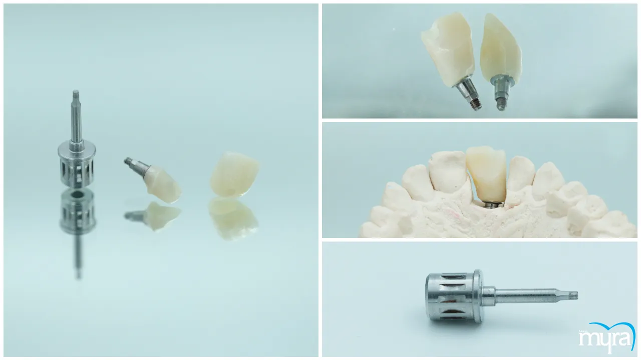 Single Tooth Dental Implant Definition Benefits Procedure and Average Cost - Myra-Dental-Centre-Turkey