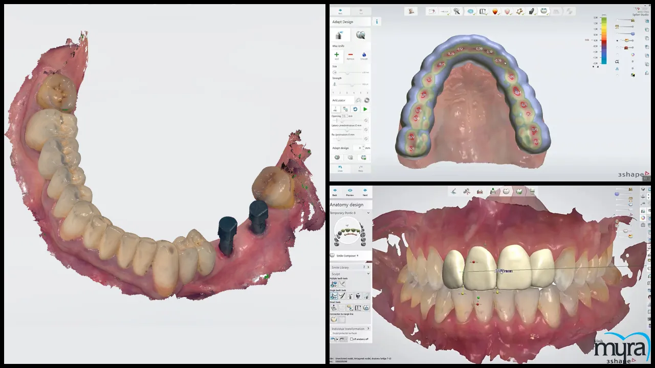 Immediate load dental implant Definition