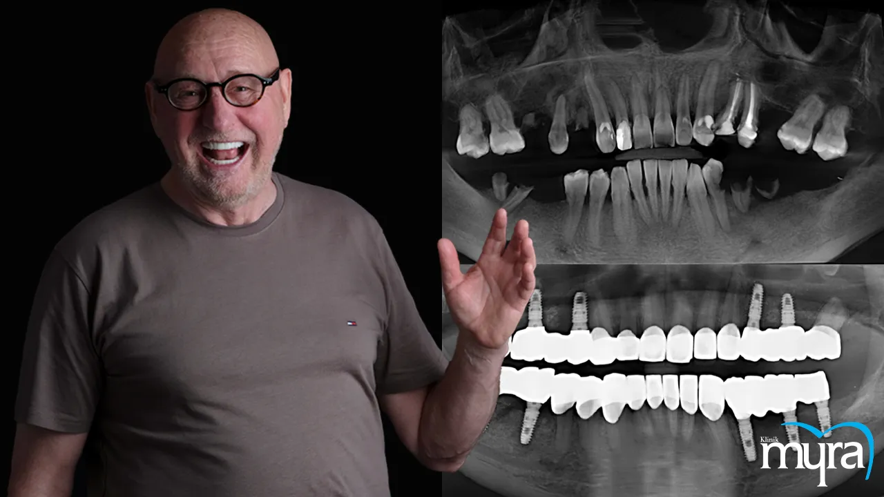 Immediate load dental implant Definition