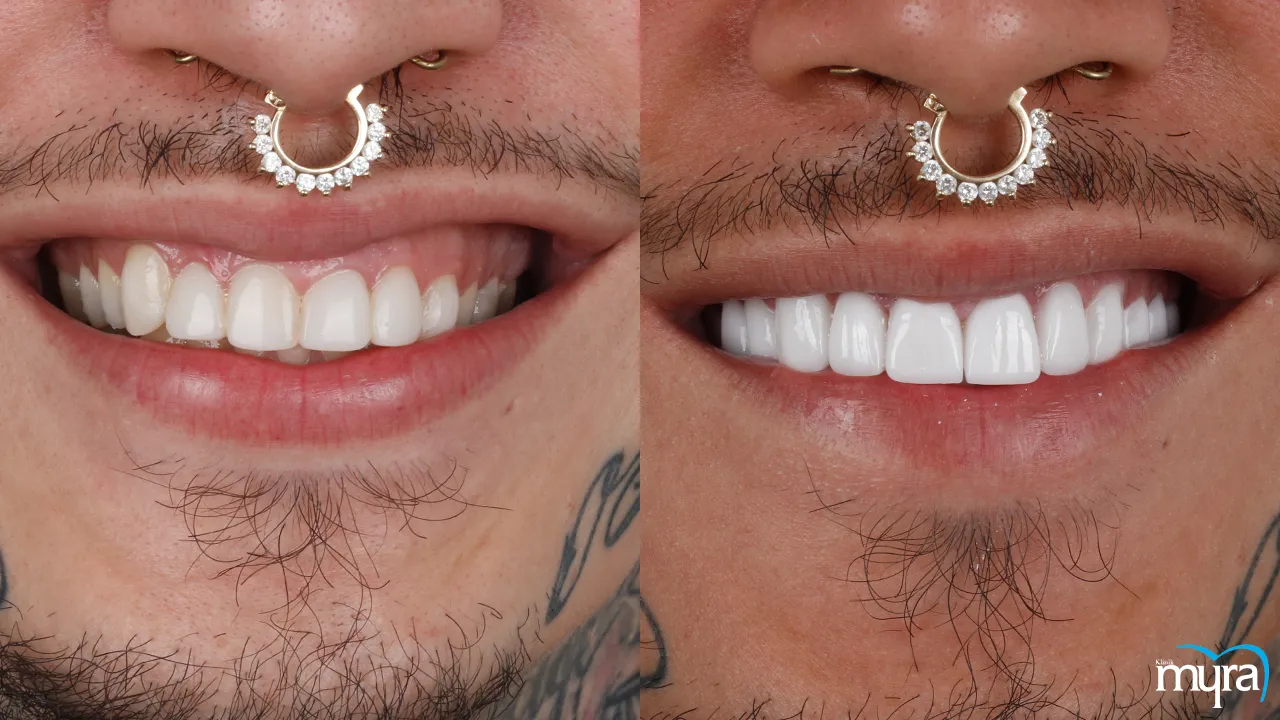 Dental Veneers vs Laminates