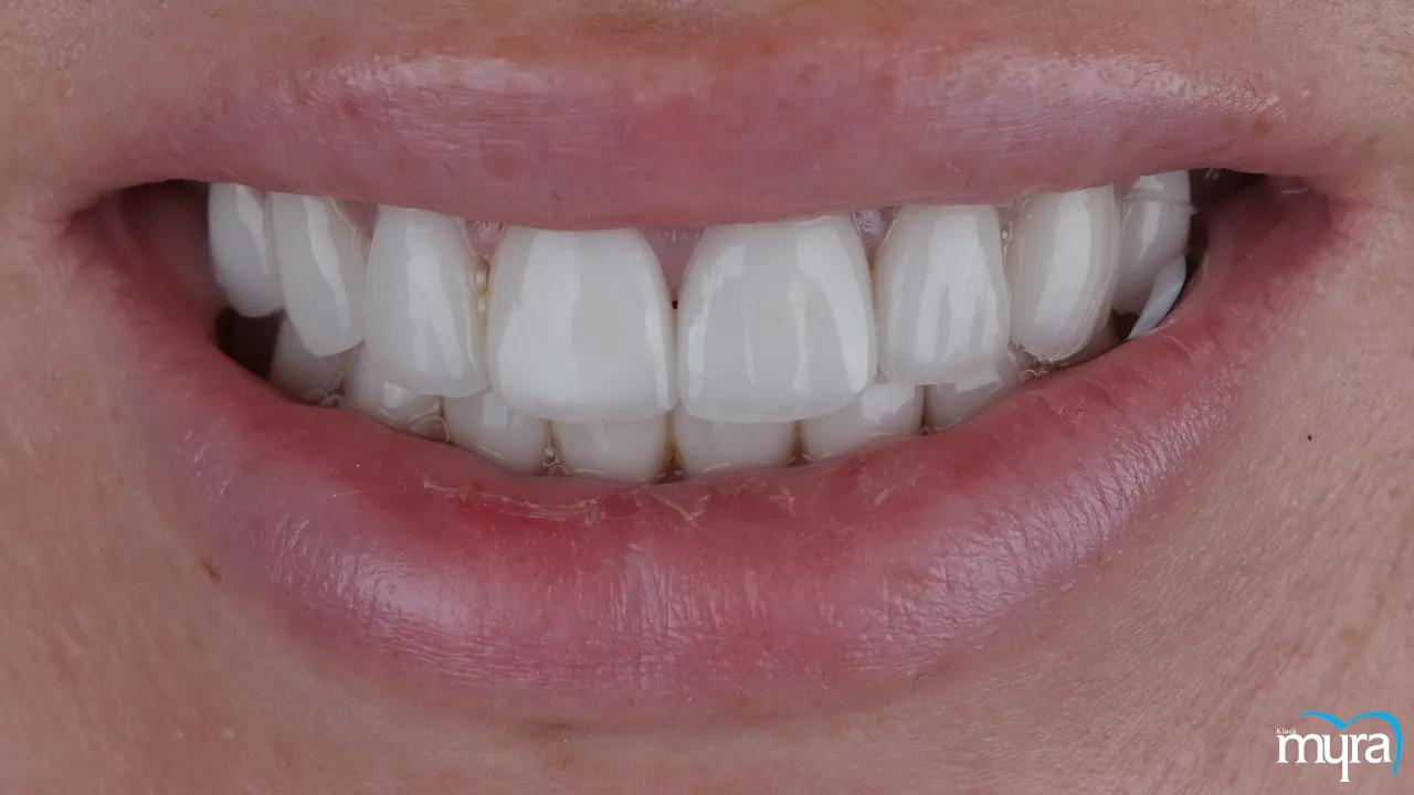 Dental Veneers vs Laminates