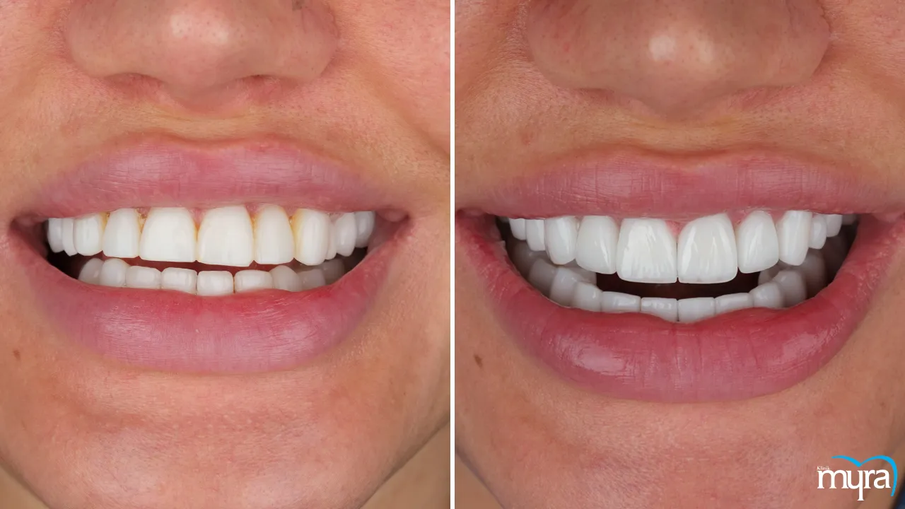 Dental Veneers Risks