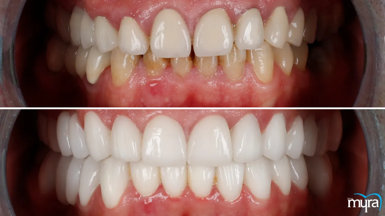 Gingival Esthetics