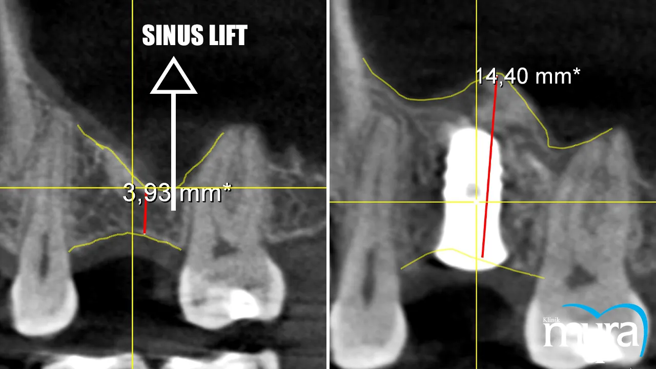 Sinus Lift Definition