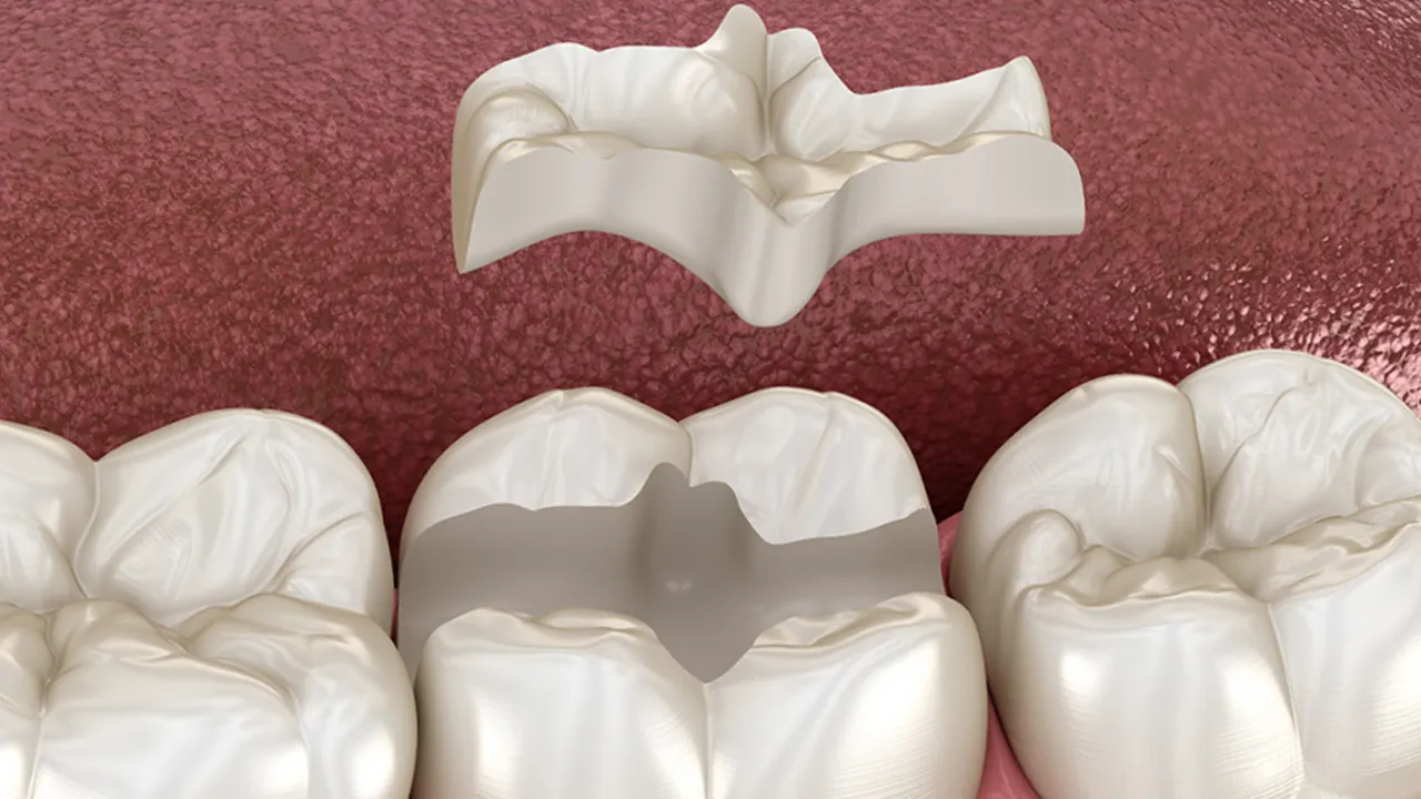 Myra Dental Centre - Inlays Definition Importance and Types 