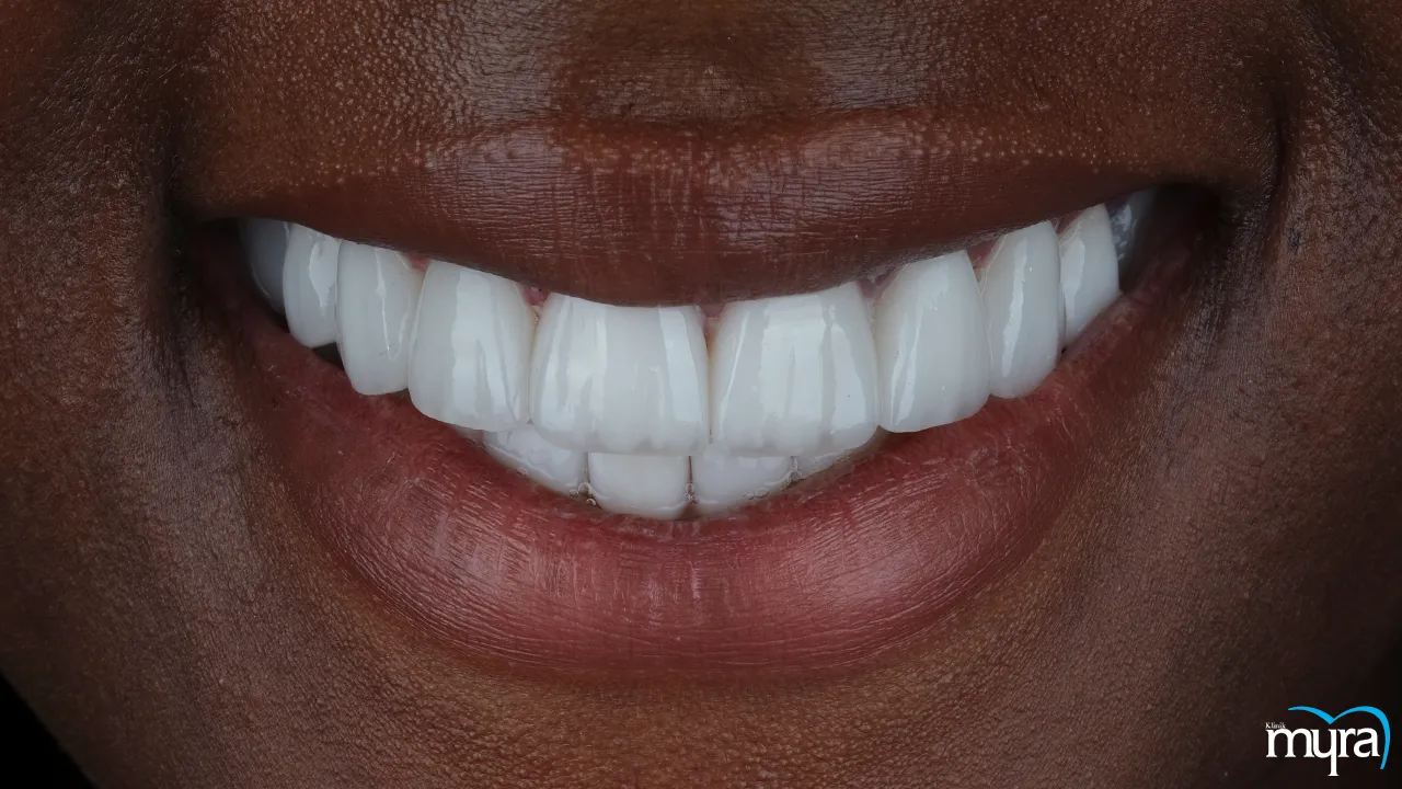 Myra Dental Centre - 7-benefits-of-dental-veneers