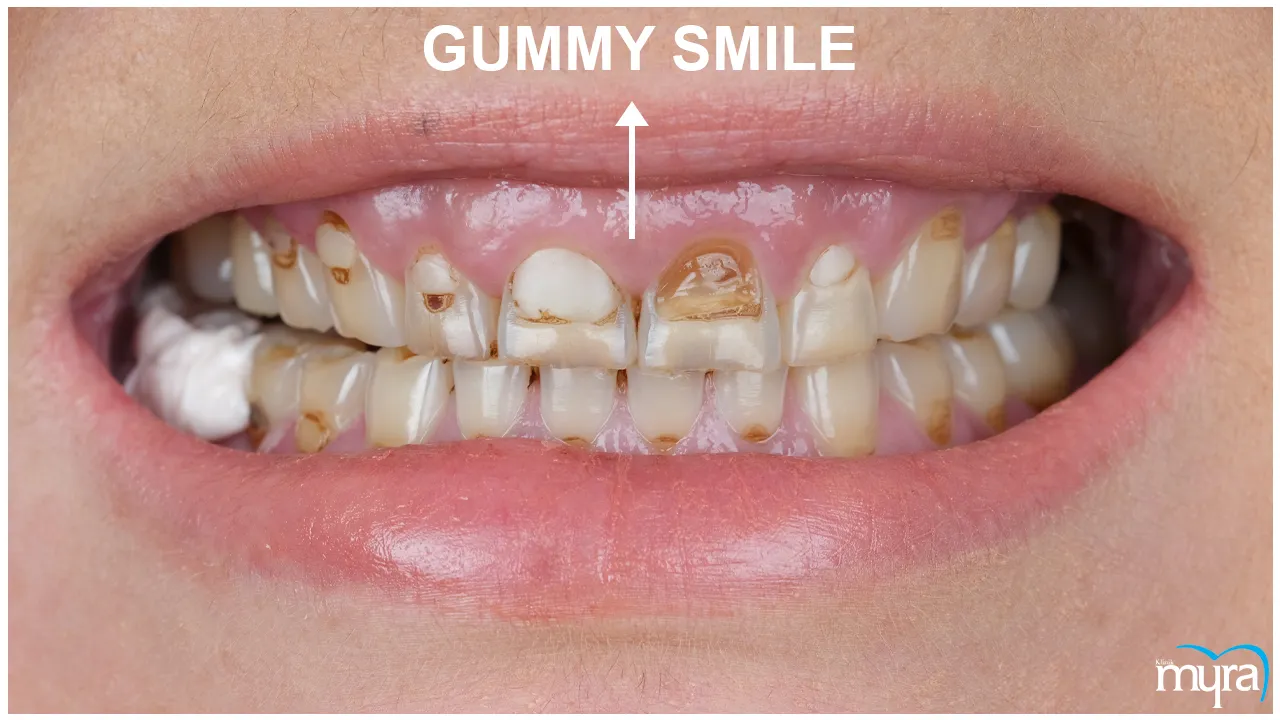 Xenograft Tissue Definition