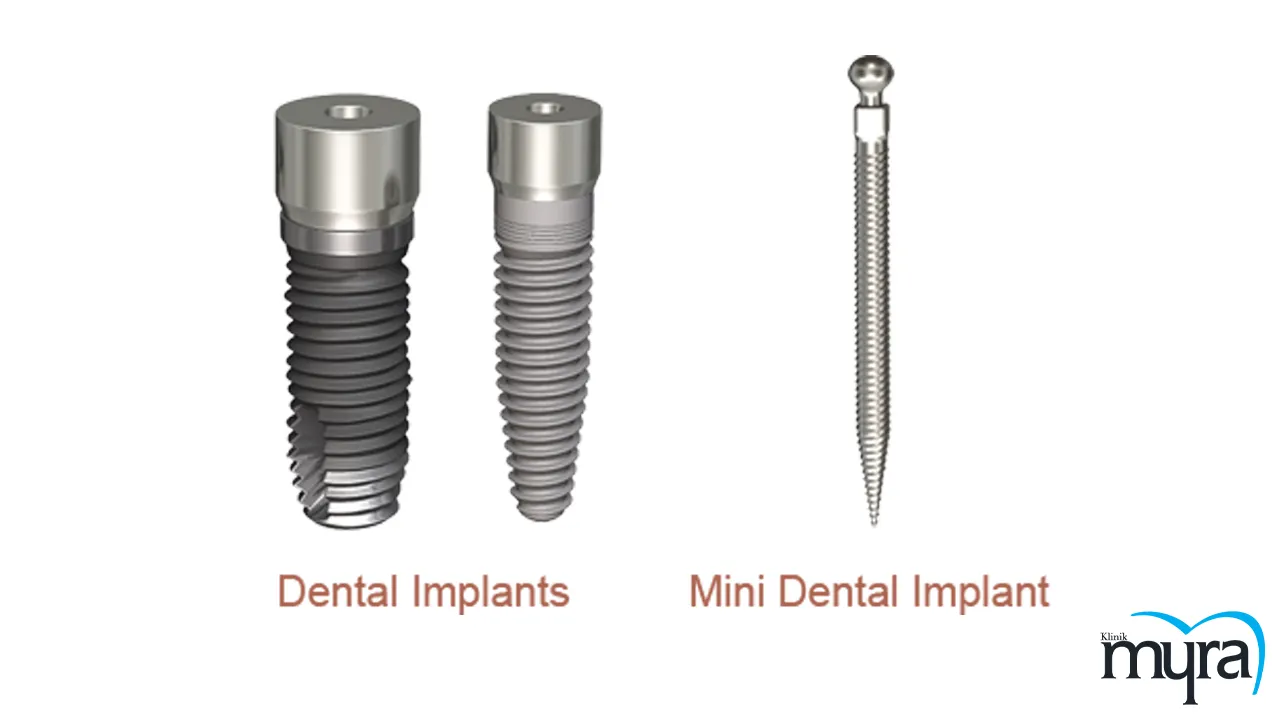 Myra Dental Centre - mini-dental-implant-definition-advantages-disadvantages-and-average-cost
