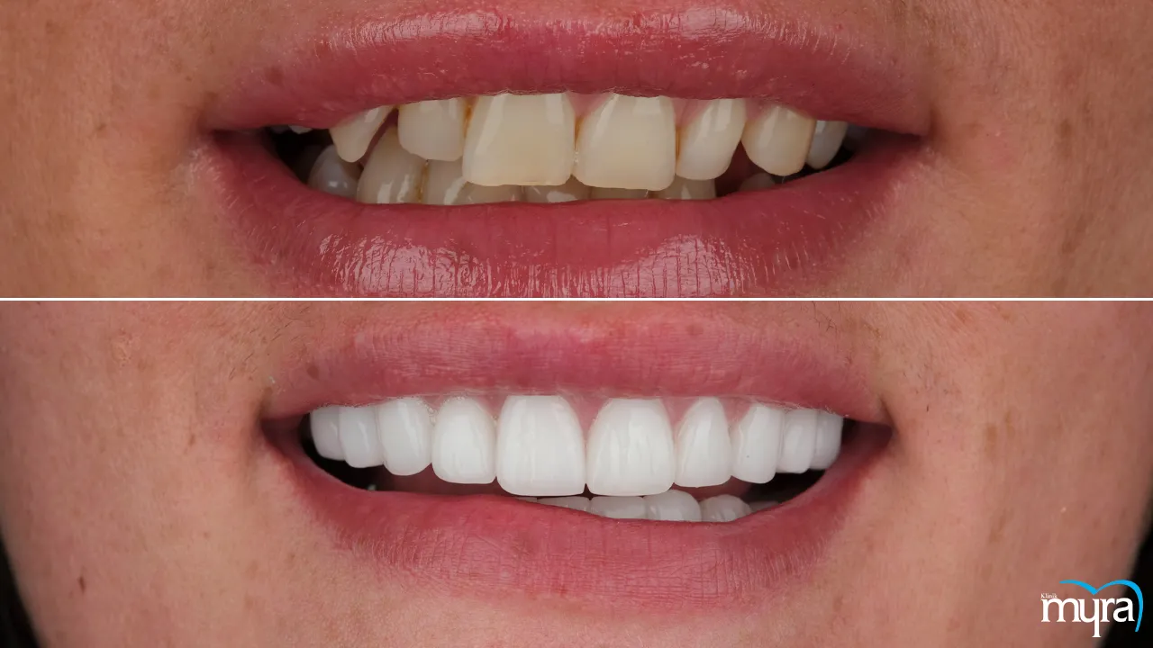 Myra Dental Centre Turkey - Narrow-smile 