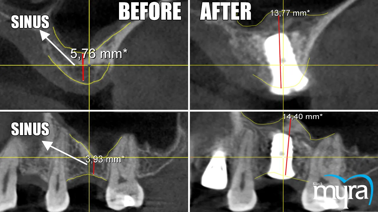 Sinus Lift Definition