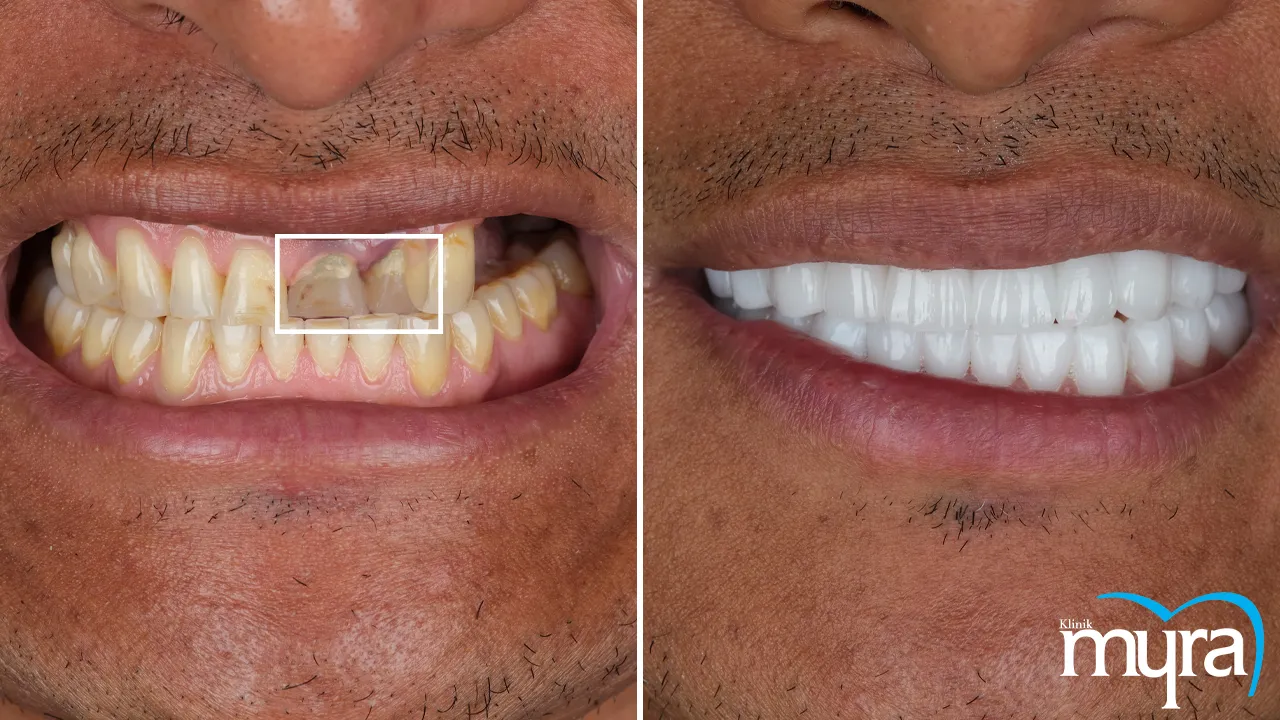 Cost of Dental Implant