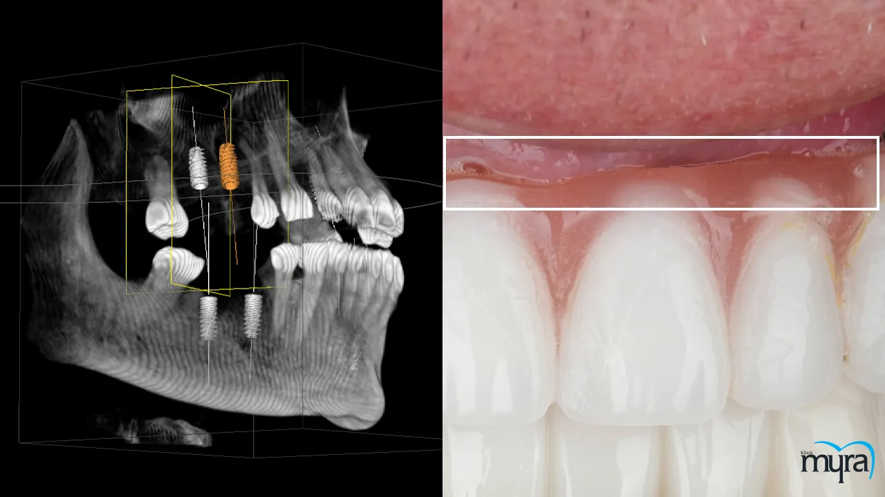 Comparative pricing and analysis of dentures in Turkey and Mexico