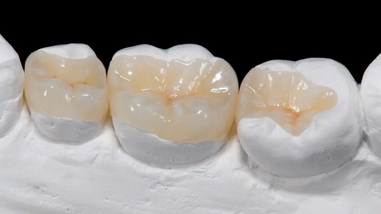 Myra Dental Centre - Inlays Definition Importance and Types 