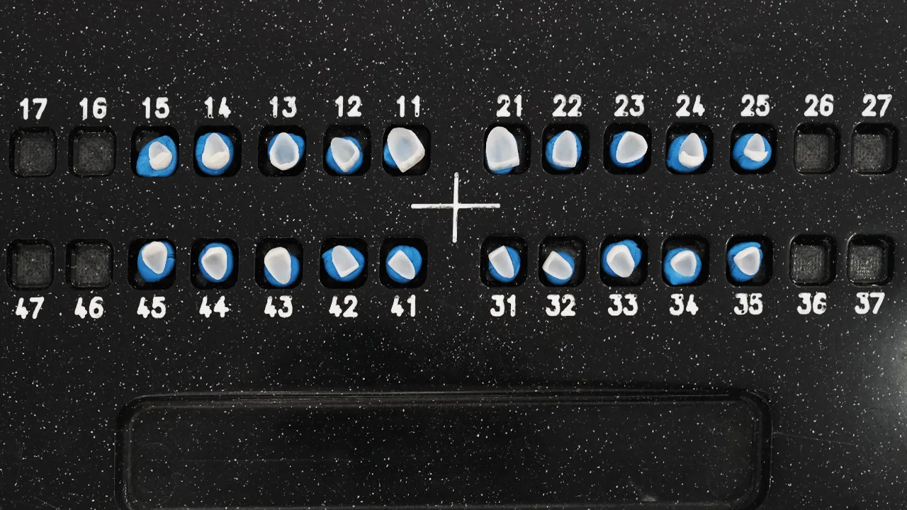 Decoding Dental Veneer Costs: Factors Behind Their Pricing