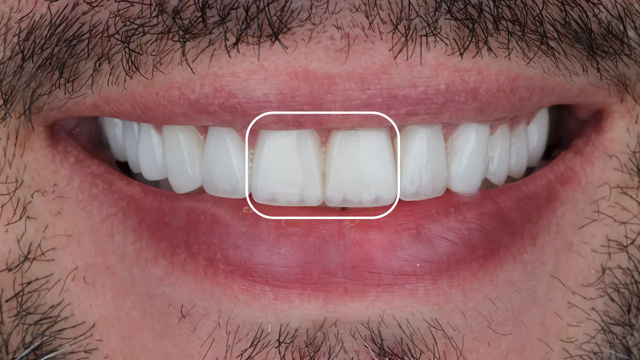 Maxillary Central Incisors