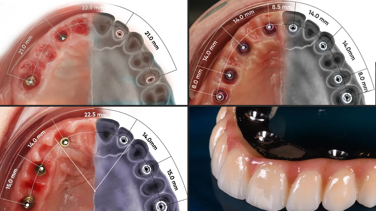 What is the maximum number of implants you can have?