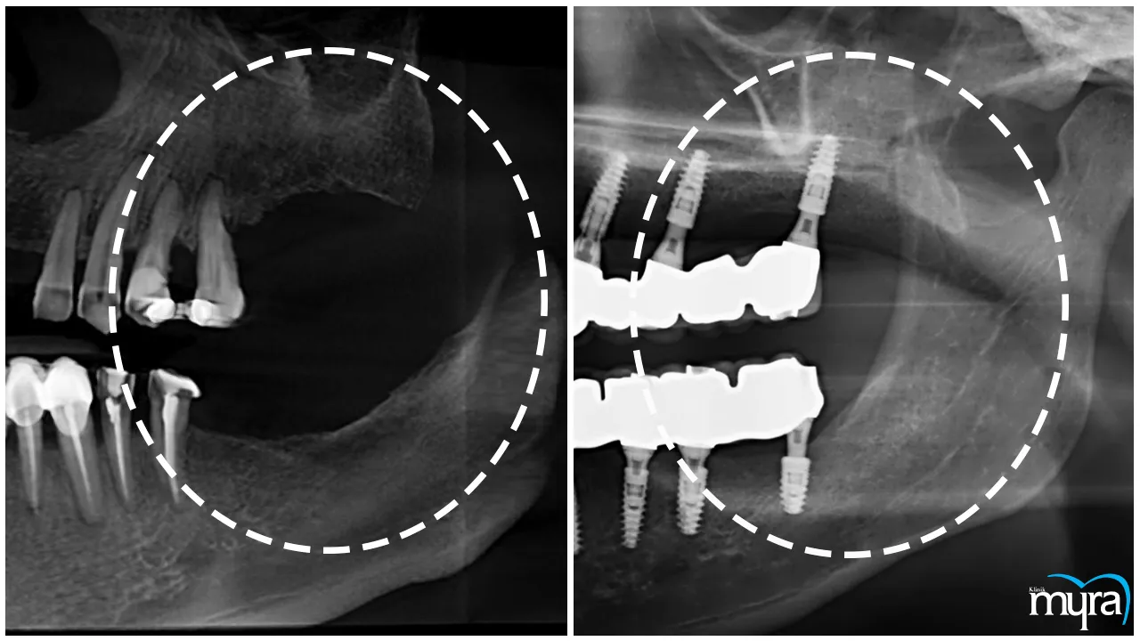 Xenograft Tissue Definition