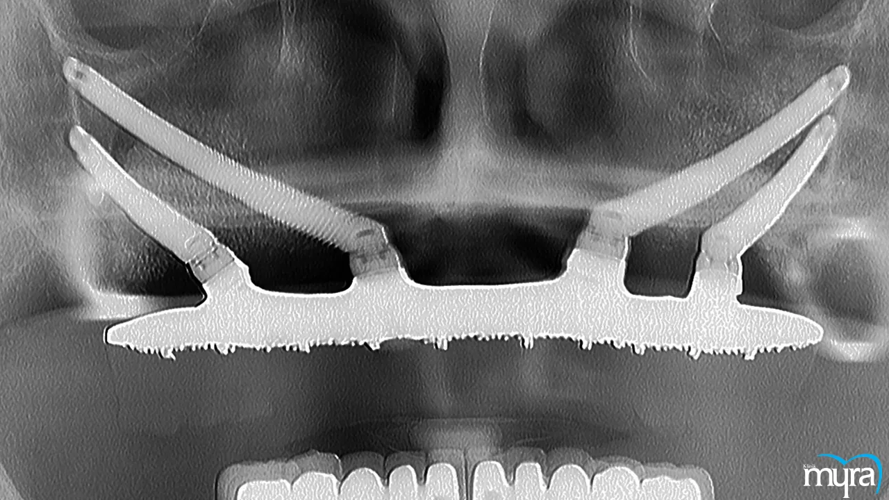 Dental implants