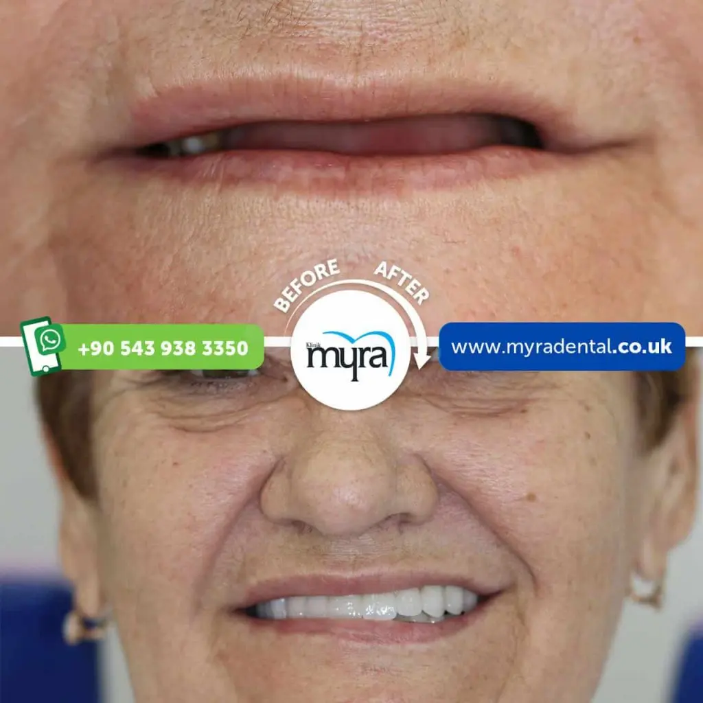 Myra Dental Centre Turkey - all-on-4-dental-implants-in-turkey