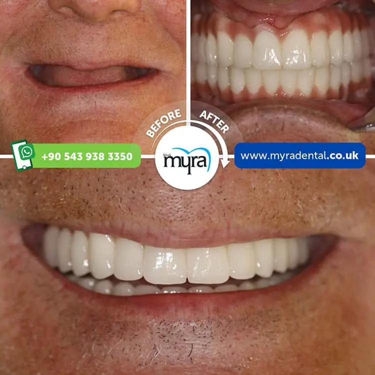 Myra Dental Centre Turkey - all-on-4-dental-implants-in-turkey