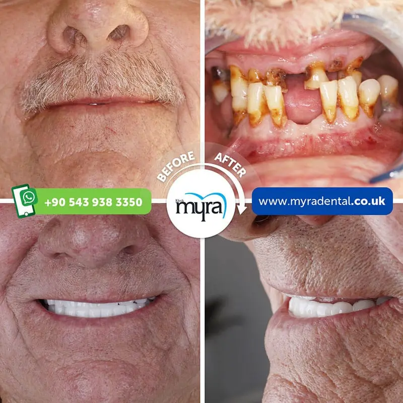 Myra Dental Centre Turkey - all-on-4-dental-implants-in-turkey