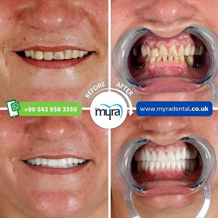Myra Dental Centre Turkey - all-you-need-to-know-about-implant-supported-new-teeth-restorations-with-implants-in-turkey