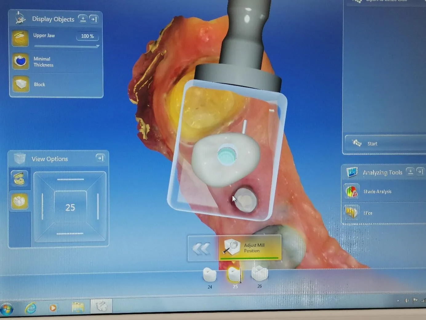 Myra Dental Centre Turkey - all-you-need-to-know-about-implant-supported-new-teeth-restorations-with-implants-in-turkey