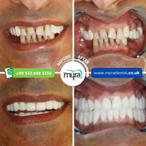 Myra Dental Centre Turkey - are-implants-worth-it