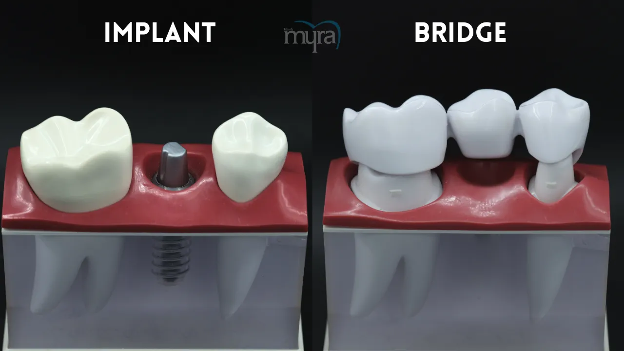 Myra Dental Centre Turkey - Pricing-details-for-dental-implants-in-the-UK