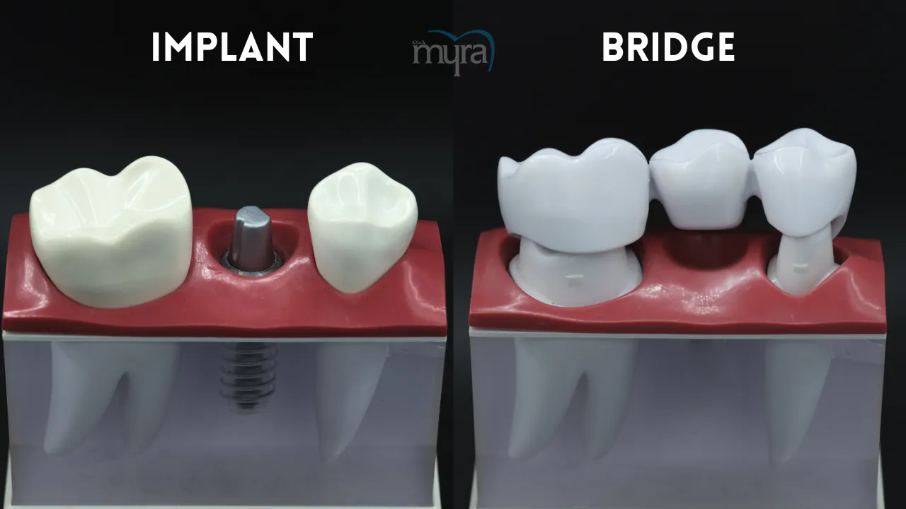 Pricing details for dental implants in the UK