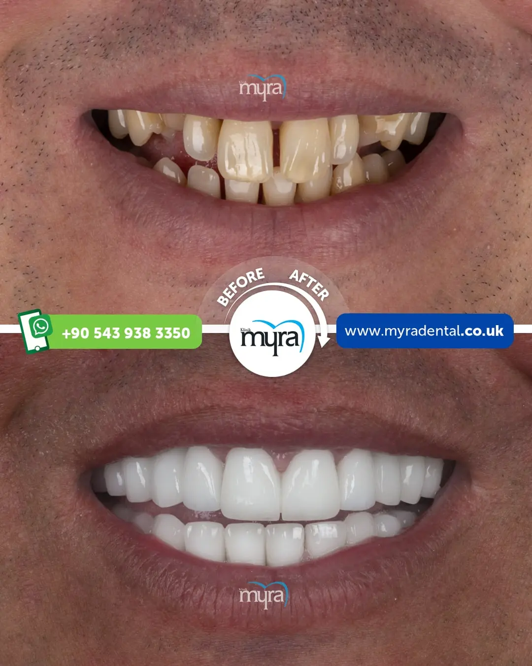 Myra Dental Centre Turkey - are-veneers-cheaper-in-turkey