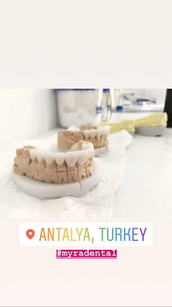 Myra Dental Centre Turkey - are-veneers-painful