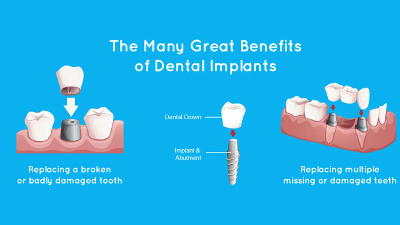Myra Dental Centre - 10-benefits-of-dental-implants
