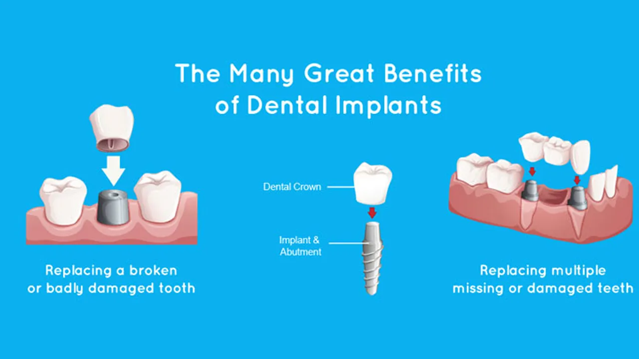 Benefits of Dental Implants