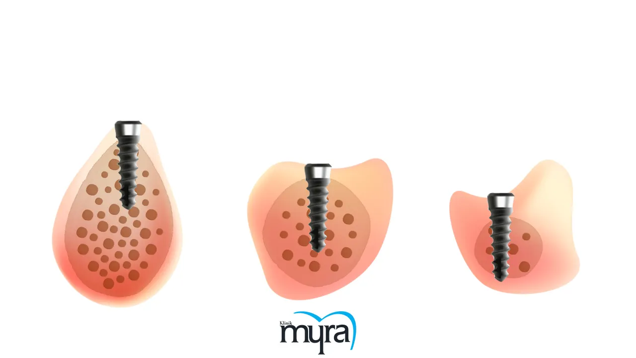 Required number of implants for supporting an upper denture