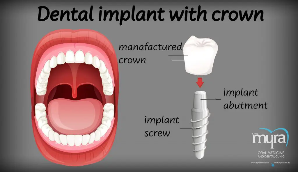 Myra Dental Centre Turkey - can-implants-be-whitened