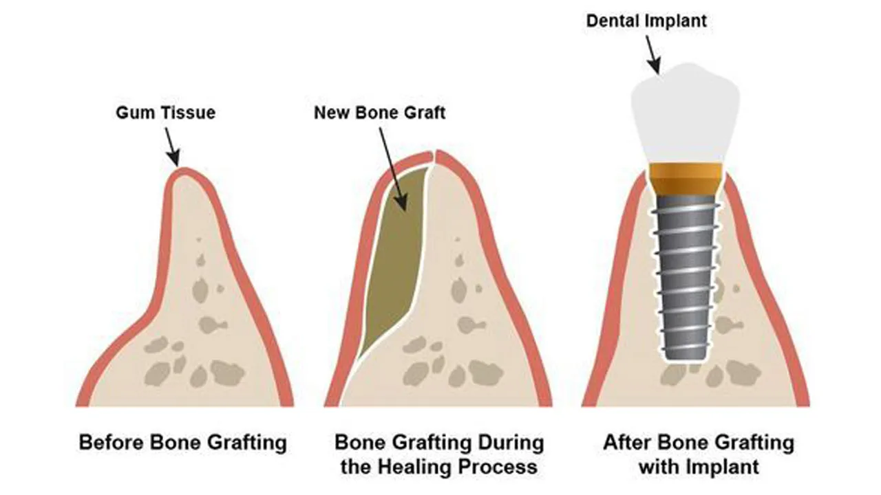 Myra Dental Centre - dental-bone-grafting-types-process-and-healing-duration