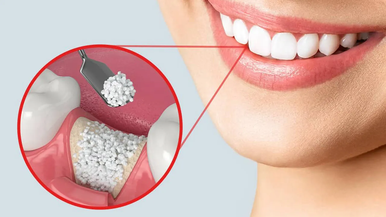 Myra Dental Centre - dental-bone-grafting-types-process-and-healing-duration
