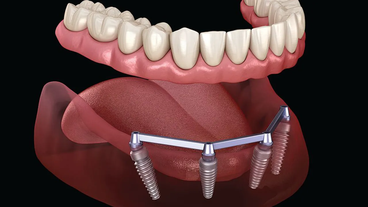 Implant Overdentures