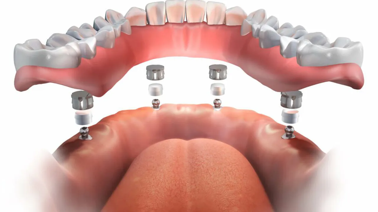 Myra Dental Centre - dental-implant-overdentures