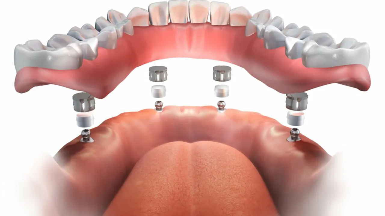 Implant Overdentures