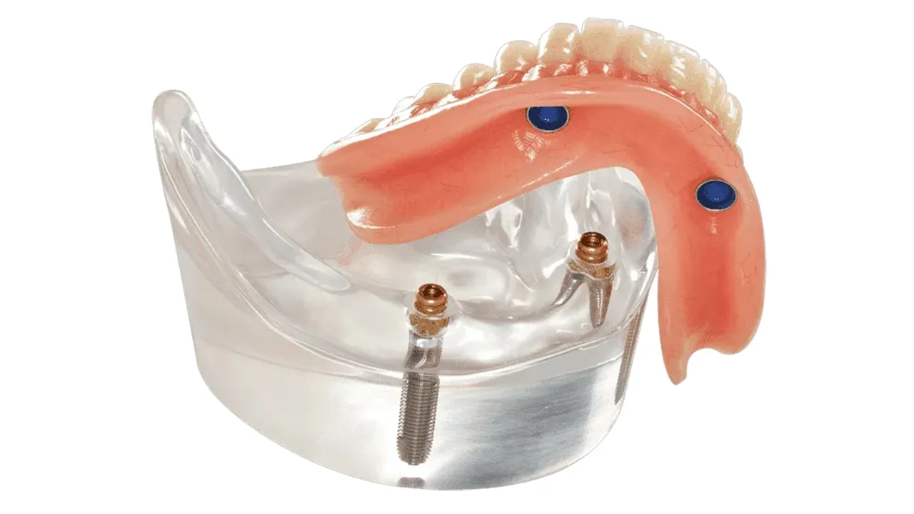 Implant Overdentures