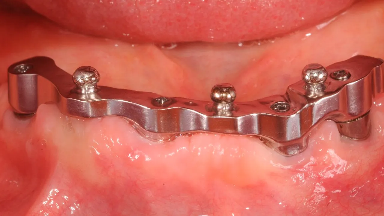 Implant Overdentures