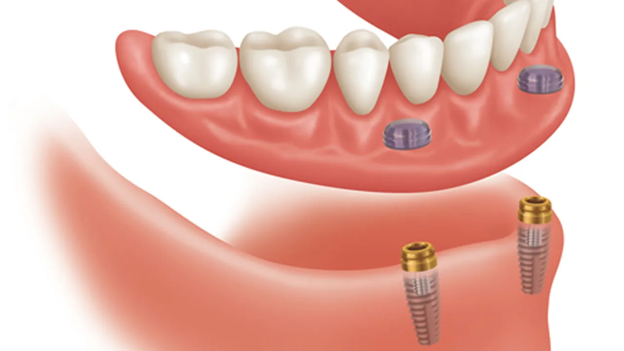 Implant Overdentures