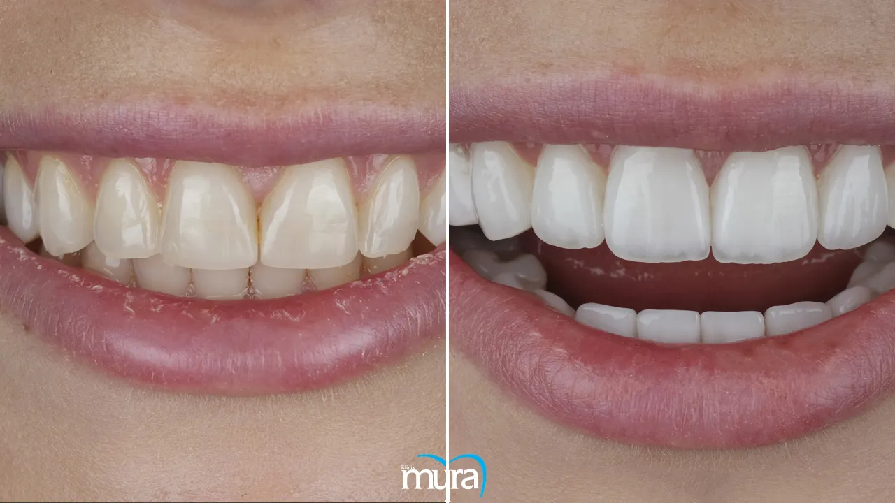 Myra Dental Centre - dental-veneers-definition-types-cost-and-recovery-duration