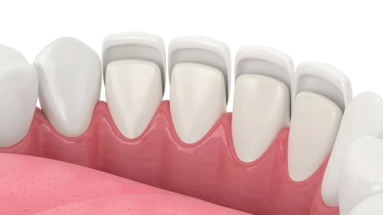 Myra Dental Centre - dental-veneers-definition-types-cost-and-recovery-duration