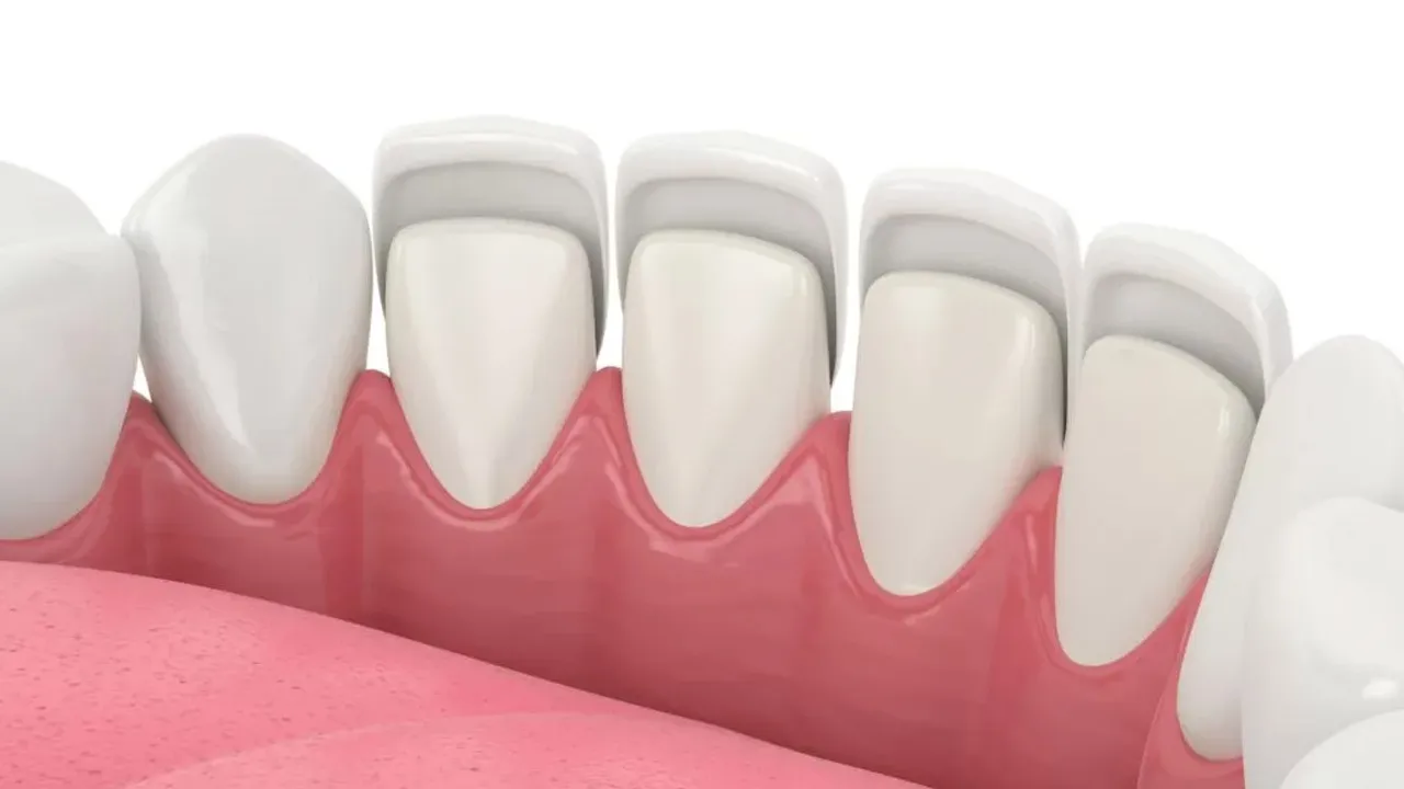 Dental Veneers Definition